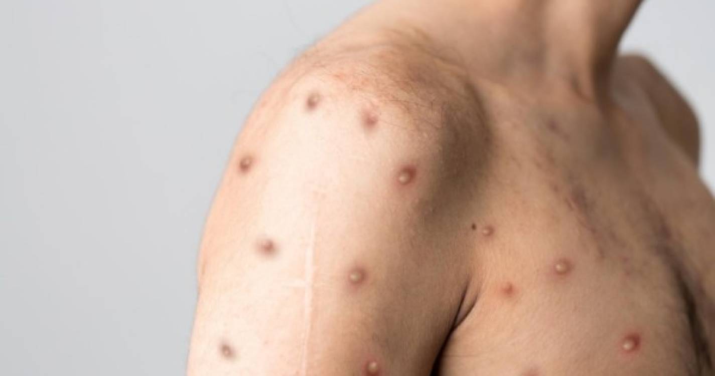 Monkeypox: Contágios aumentaram 20% na última semana em todo o mundo - OMS