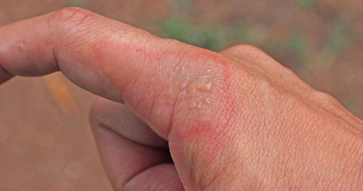 Madeira enfrenta surto de impetigo, uma infeção da pele contagiosa